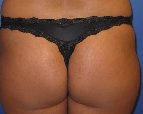 Client before an external gluteal-contouring treatment course