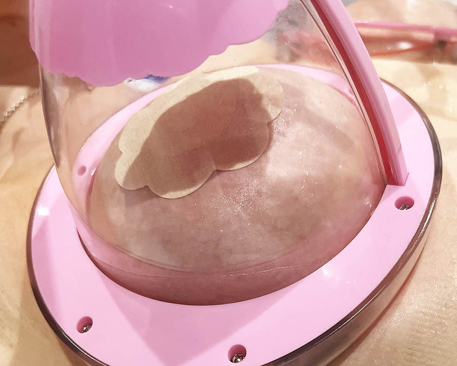 Clinic-based vacuum cup appointment shown without an outcome claim