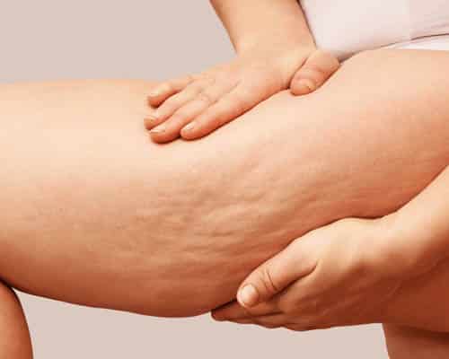 Upper-thigh skin texture discussed during an appointment in Leeds