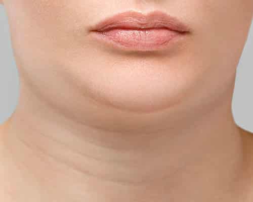Under-chin cryolipolysis handpiece in position during treatment