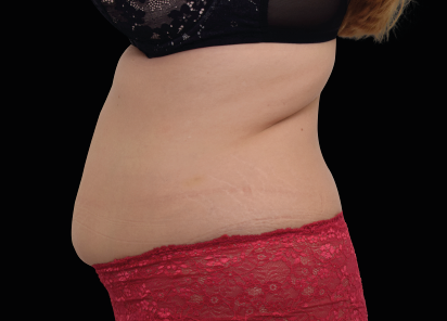 External EMSculpt applicators secured over a suitable body area