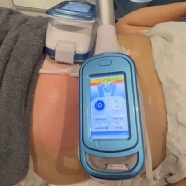Practitioner demonstrating a cryolipolysis cup for area mapping