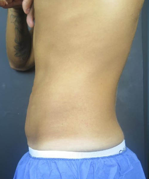 Side profile recorded before abdominal cryolipolysis