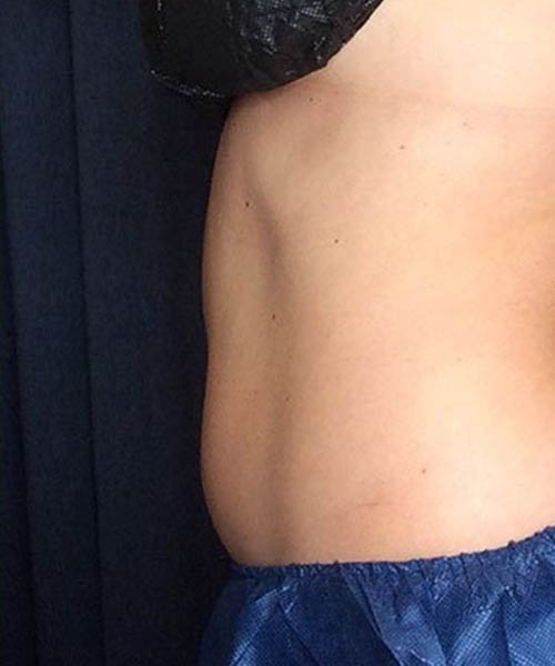 Comparable stomach view at a later review