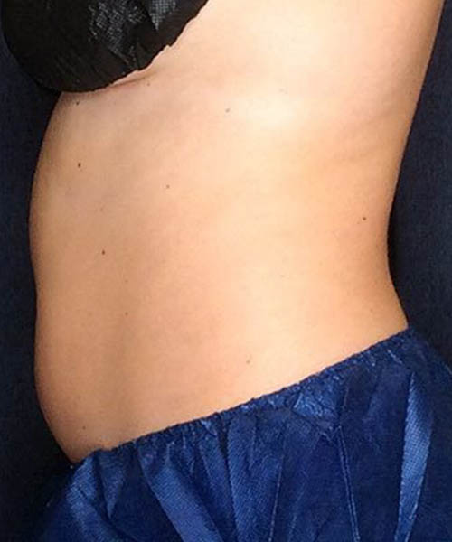 Front-oblique stomach view before cooling