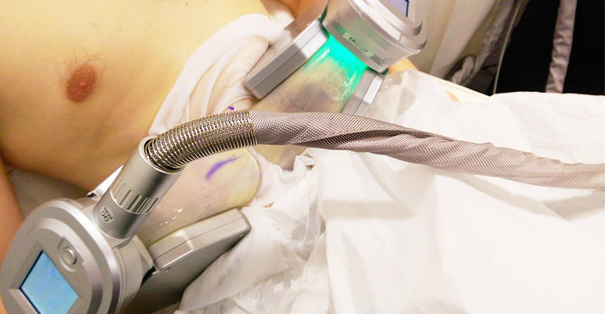 Practitioner checking the fit of a fat-freezing cup on a Leeds client
