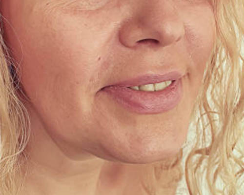 Facial treatment area photographed before HIFU