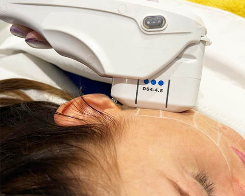 Focused-ultrasound applicator used over a planned lower-face zone