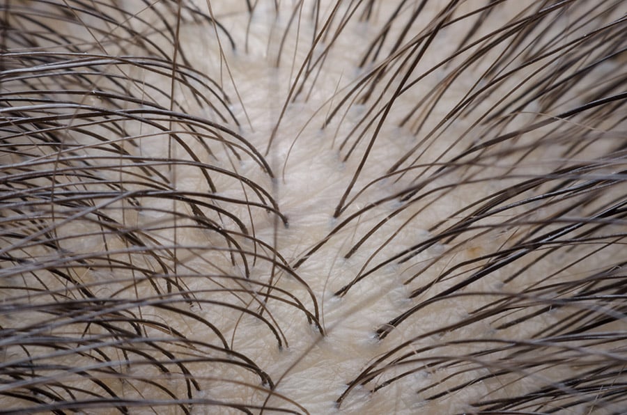 Scalp positioned below a low-level light device in Leeds