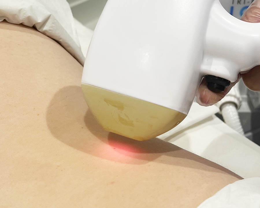 Laser applicator positioned over a selected area during a Leeds hair-reduction session