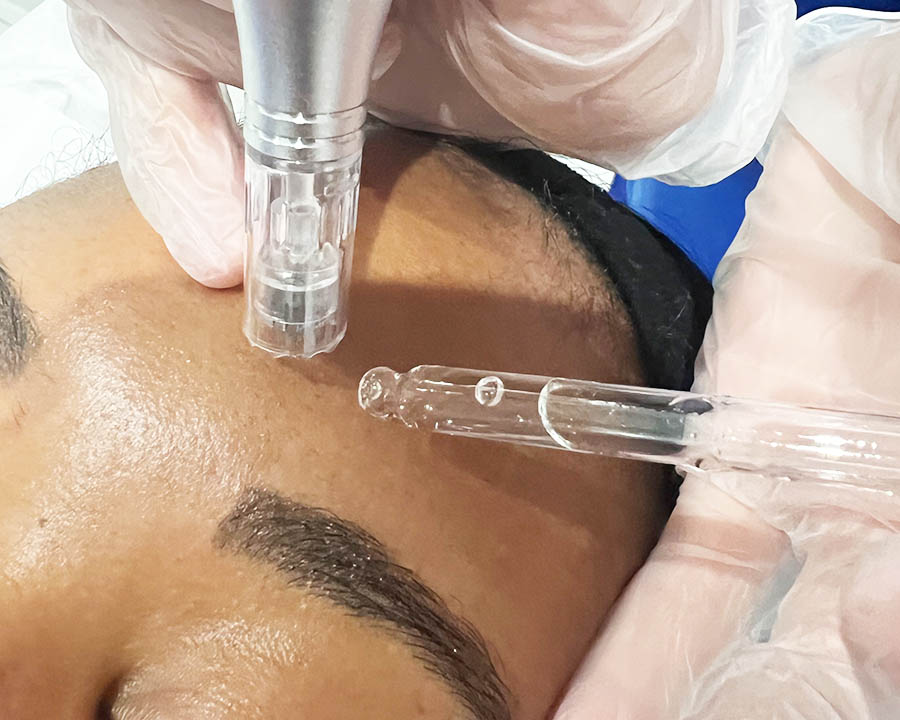 Microneedling device applied methodically to suitable facial skin in Leeds
