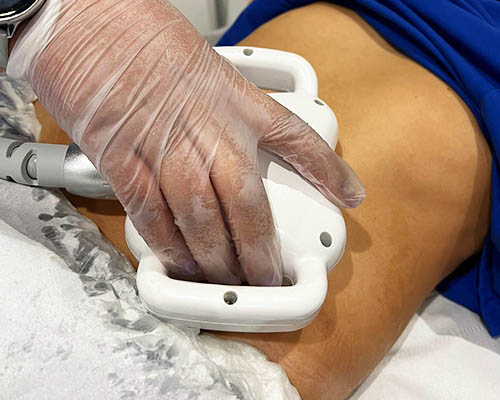 External RF body applicator used on an abdominal treatment area