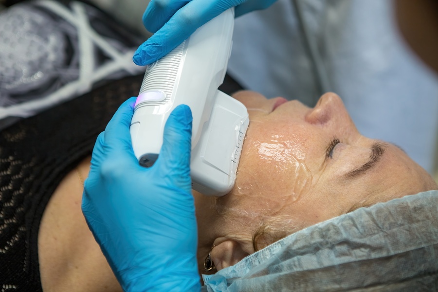 Morpheus8 radiofrequency microneedling treatment on a suitable Leeds client