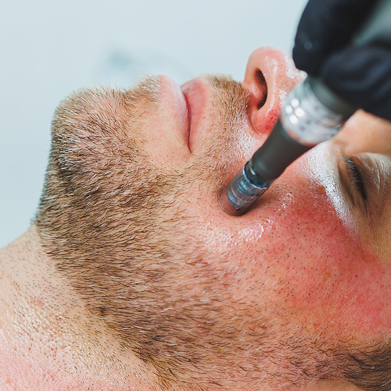 Microneedling treatment being performed on a man's cheek