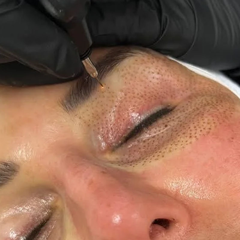 Plasma eye treatment being performed on a man's eyelid