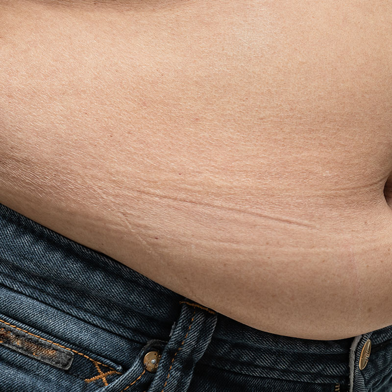 A man's abdomen before a body skin-tightening treatment